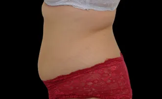 Body-After-1