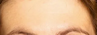 RR_Botox_beforeafter4-After