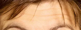 RR_Botox_beforeafter4-Before