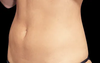 RR_emsculpt_beforeafter4-After
