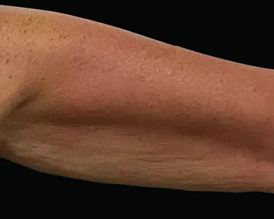 Rakus-Exilis-BAs4