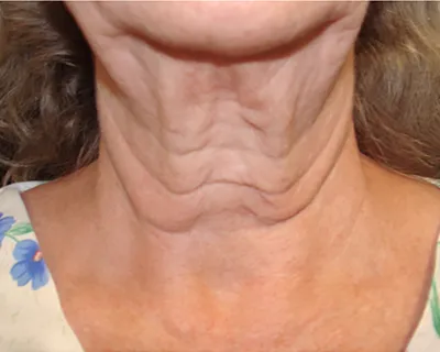 Rakus-Exilis-BAs7