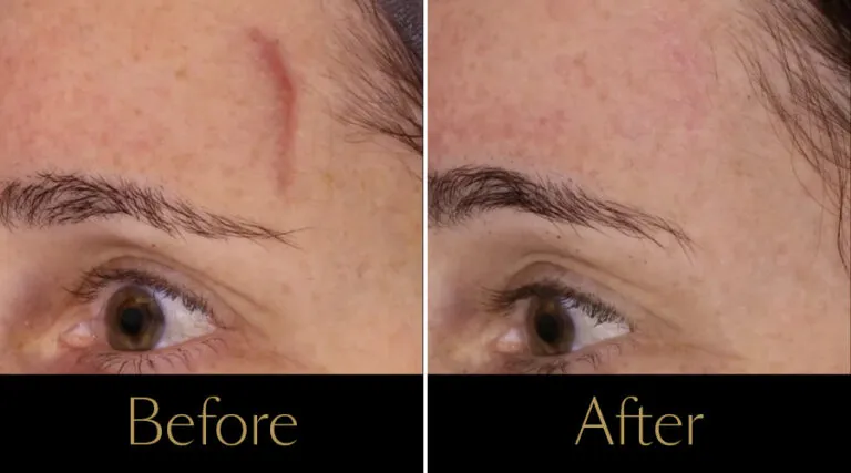 rakus-ipl-beforeafter5
