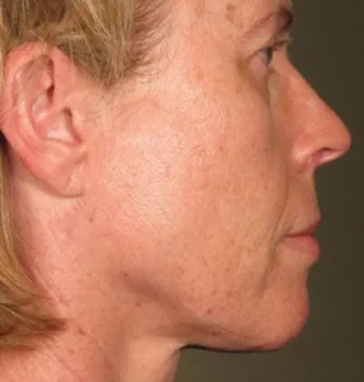 rakus-ultherapy-prime-ba-new2