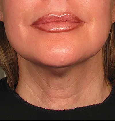 rakus-ultherapy-prime-ba8