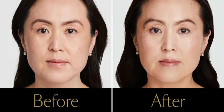rakus-ultherapy-prime-gallery-new