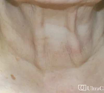 rakus-ultraclear-beforeafter-neck2