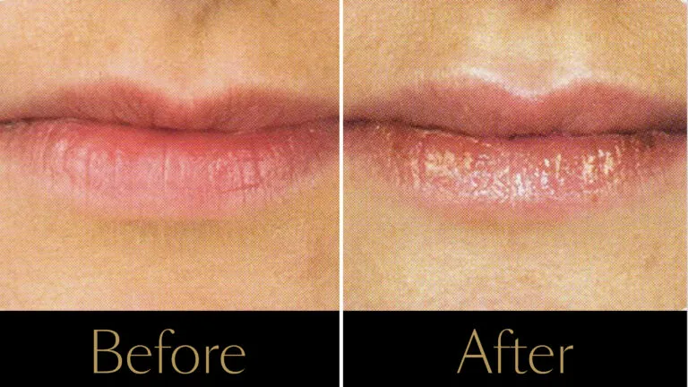 filler-lip-example