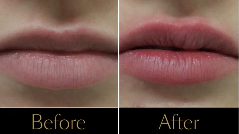lip-laser-example